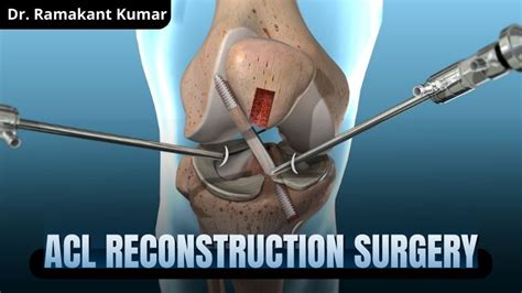 ACL Reconstruction Surgery: Procedure and Recovery .